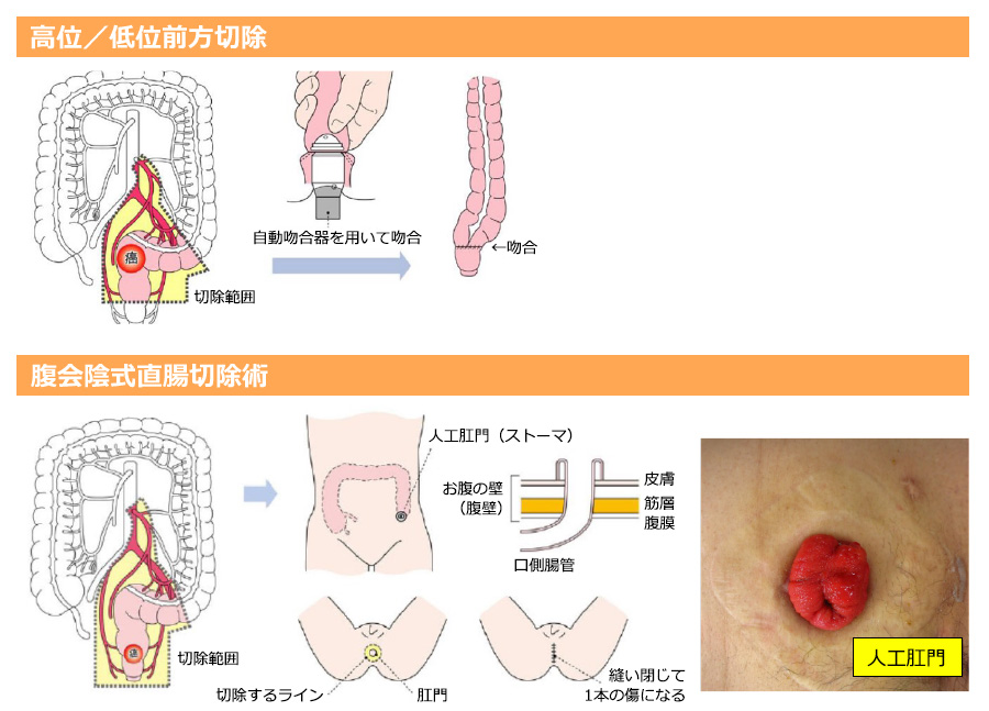 図11：直腸がんの術式