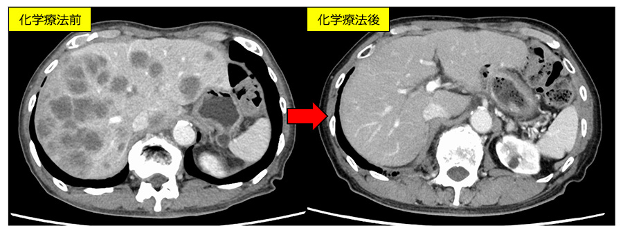 図13：化学療法治療例（大腸がん多発肝転移）