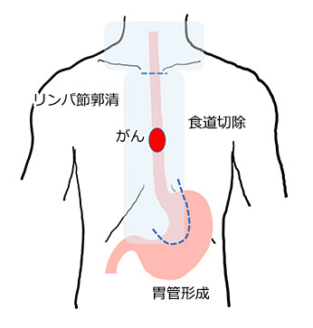 外科的治療