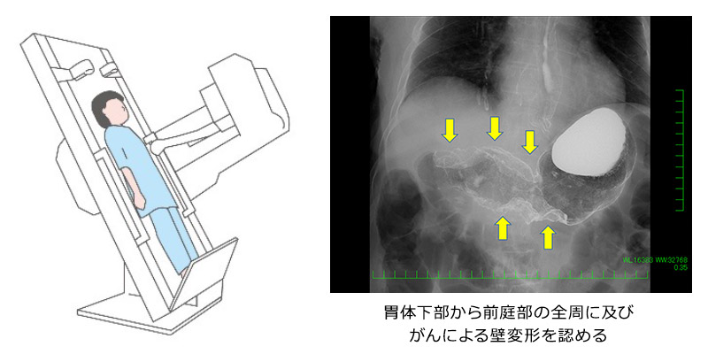 胃がん検診