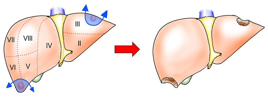 肝部分切除