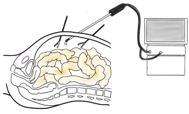 審査腹腔鏡